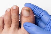 Definition and Diagnosis of Onychomycosis