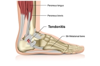 Effective Stretches for the Achilles Tendon