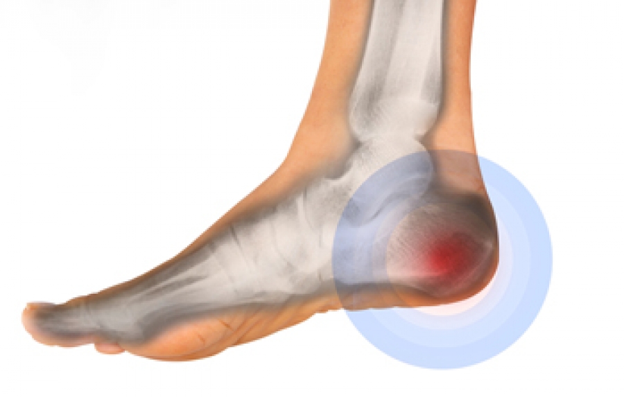 What is the Recovery Time for Heel Spur Surgery? | The Bunion Cure